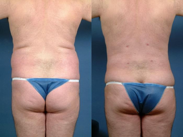 Before & After Liposuction for Men Case 719 Back View in Louisville & Lexington, KY