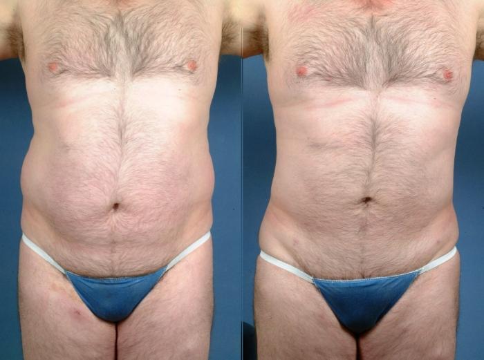 Before & After Liposuction Case 719 Front View in Louisville & Lexington, KY