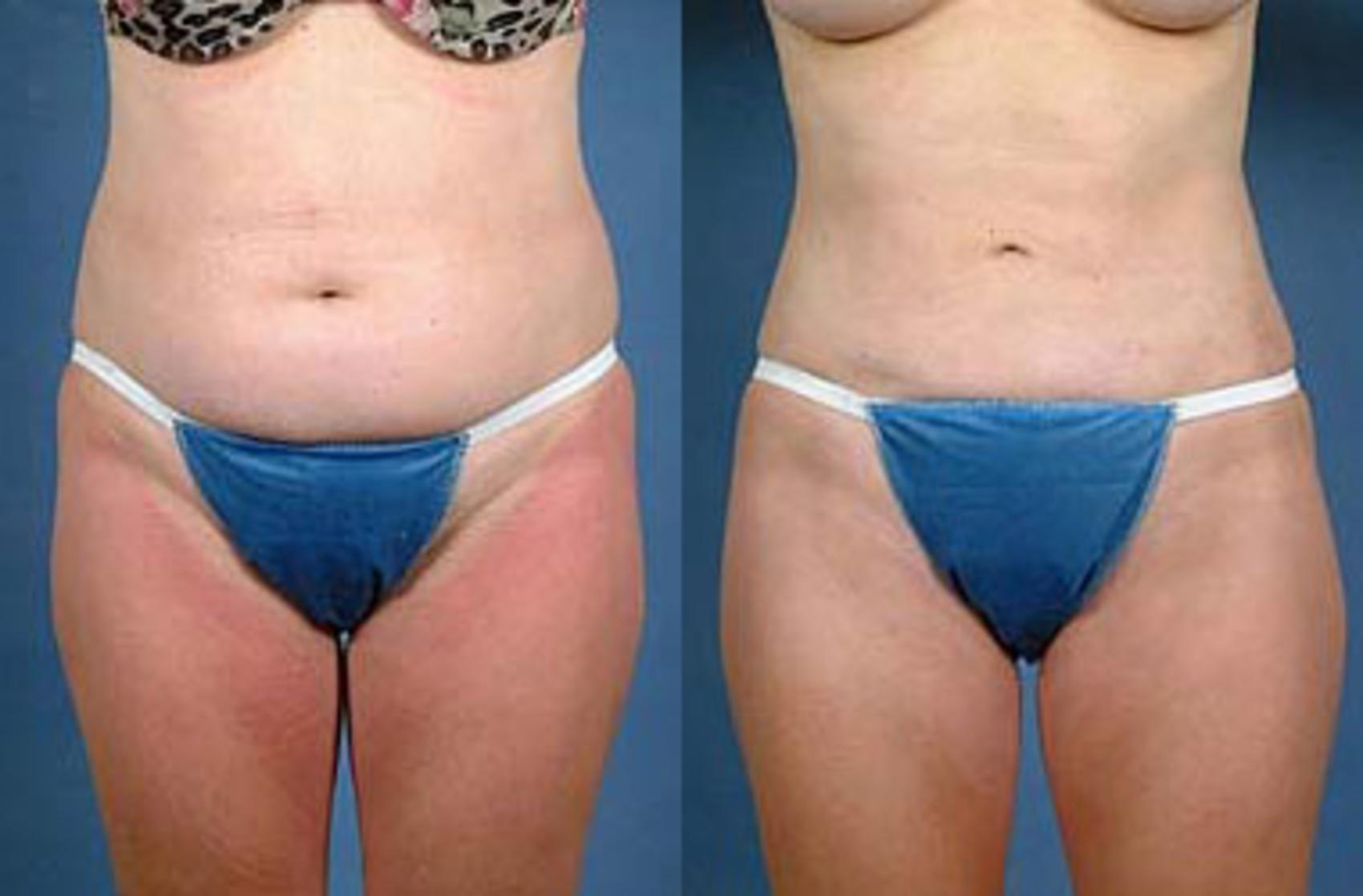 Before & After Liposuction for Women Case 114 View #1 View in Louisville & Lexington, KY