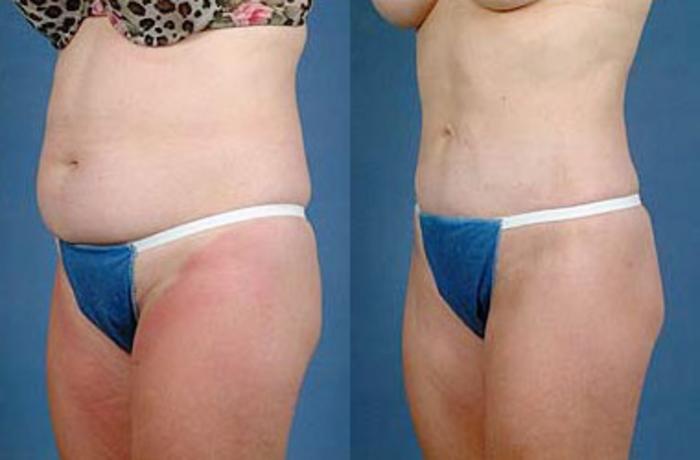 Liposuction for Women Case 114 Before & After View #2 | Louisville, KY | CaloSpa® Rejuvenation Center