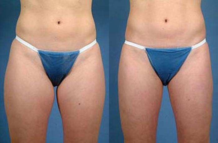 Before & After Liposuction for Women Case 116 View #1 View in Louisville & Lexington, KY