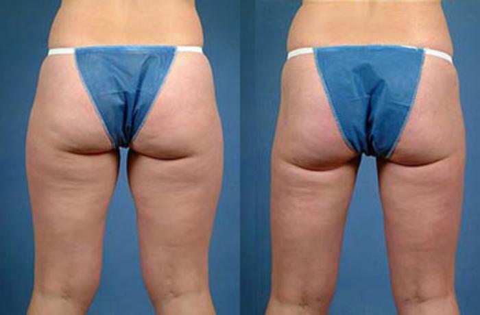 Liposuction for Women Case 116 Before & After View #2 | Louisville, KY | CaloSpa® Rejuvenation Center