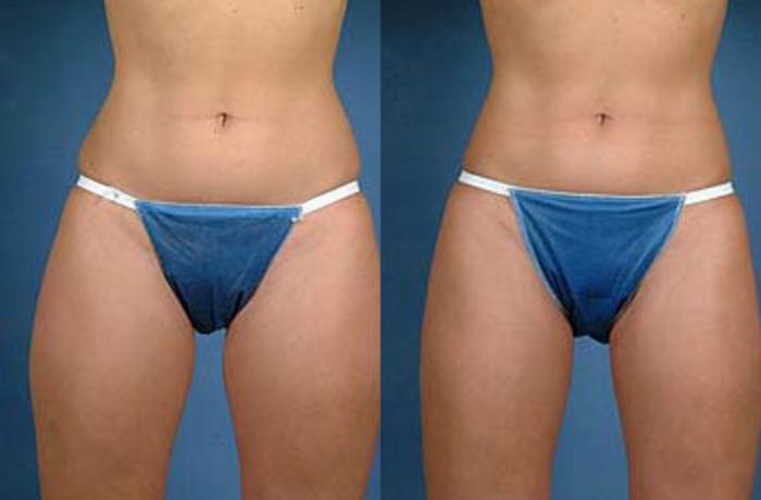 Before & After Liposuction for Women Case 118 View #1 View in Louisville & Lexington, KY