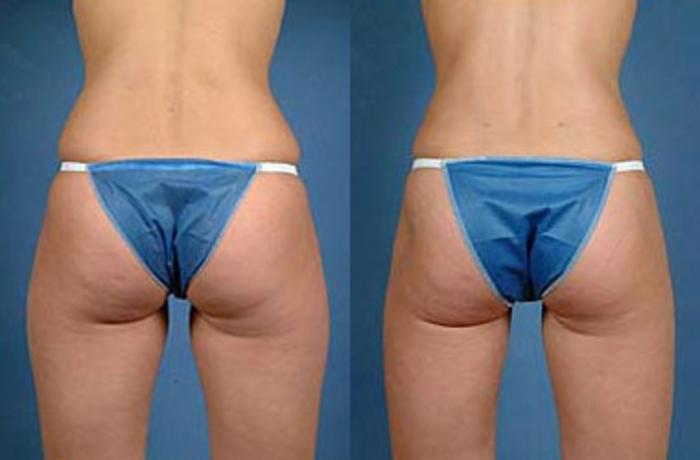 Liposuction for Women Case 118 Before & After View #2 | Louisville, KY | CaloSpa® Rejuvenation Center