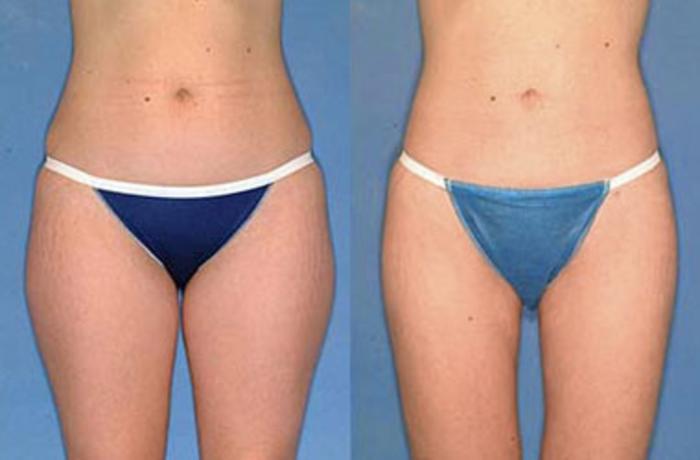 Liposuction for Women Case 124 Before & After View #1 | Louisville, KY | CaloSpa® Rejuvenation Center