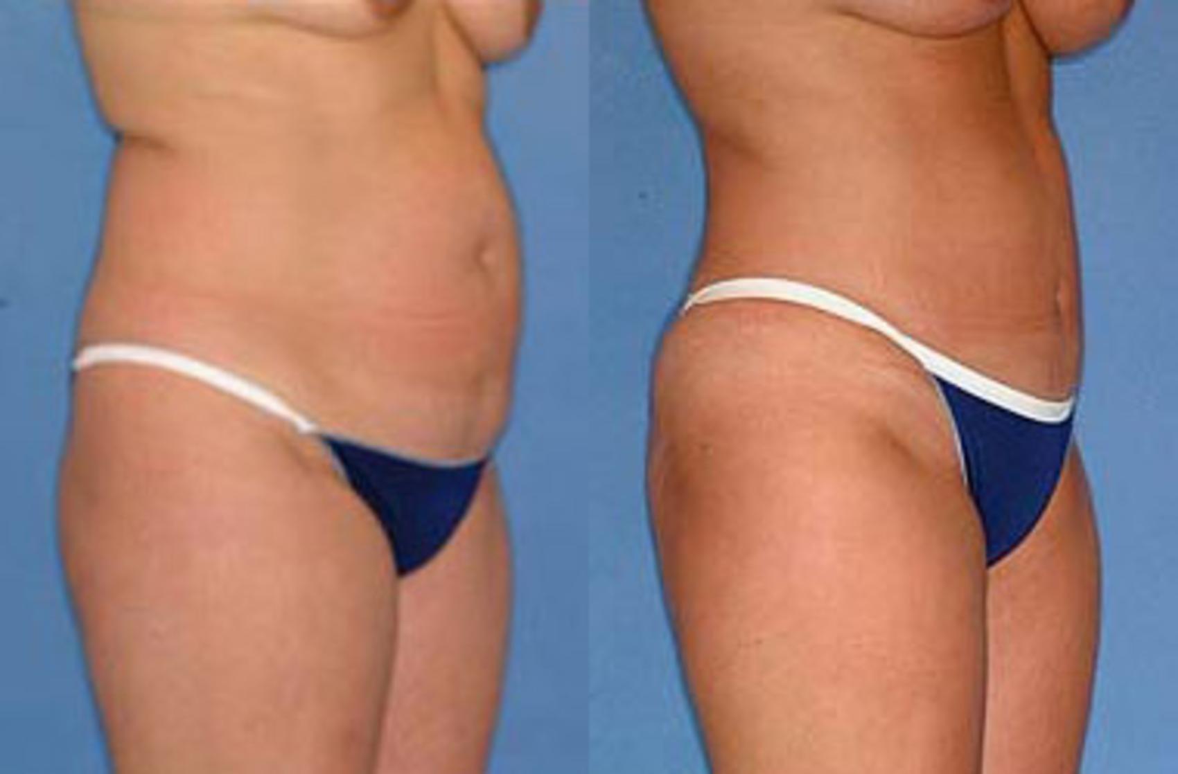Before & After Liposuction for Women Case 125 View #1 View in Louisville & Lexington, KY