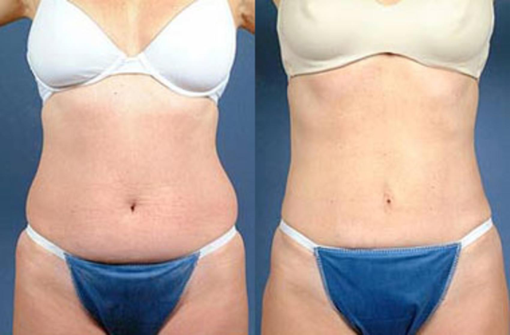 Before & After Liposuction for Women Case 127 View #1 View in Louisville & Lexington, KY