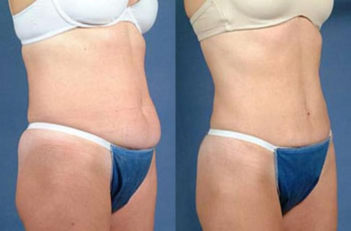 Liposuction for Women Case 127 Before & After View #2 | Louisville, KY | CaloSpa® Rejuvenation Center
