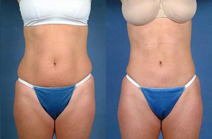 Before & After Liposuction for Women Case 128 View #1 View in Louisville & Lexington, KY