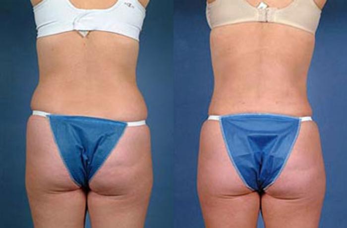 Before & After Liposuction for Women Case 128 View #2 View in Louisville & Lexington, KY