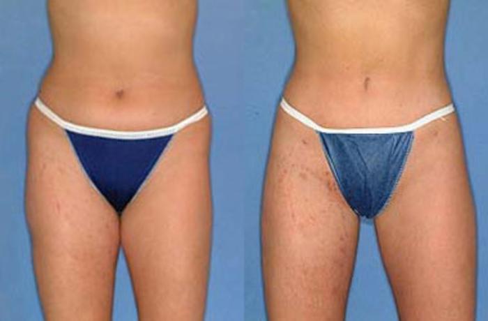 Liposuction for Women Case 130 Before & After View #1 | Louisville, KY | CaloSpa® Rejuvenation Center