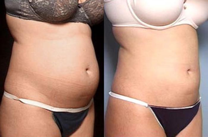 Liposuction for Women Case 133 Before & After View #1 | Louisville, KY | CaloSpa® Rejuvenation Center