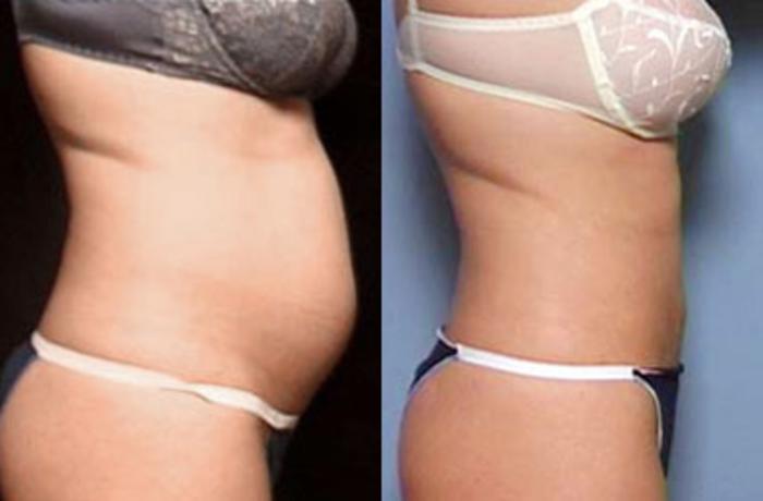 Liposuction for Women Case 133 Before & After View #2 | Louisville, KY | CaloSpa® Rejuvenation Center
