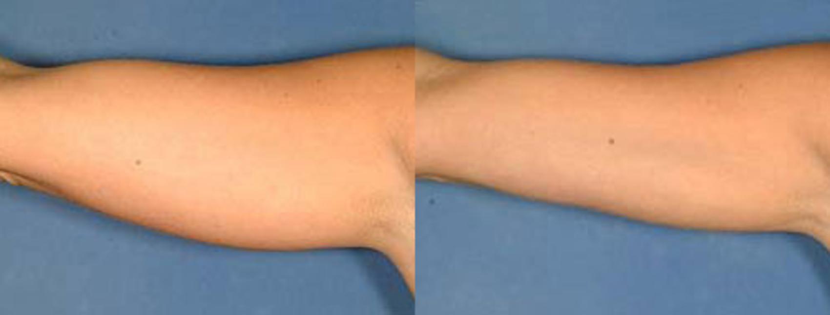Before & After Liposuction for Women Case 136 View #1 View in Louisville & Lexington, KY
