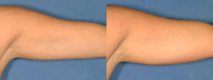 Before & After Liposuction for Women Case 136 View #2 View in Louisville & Lexington, KY