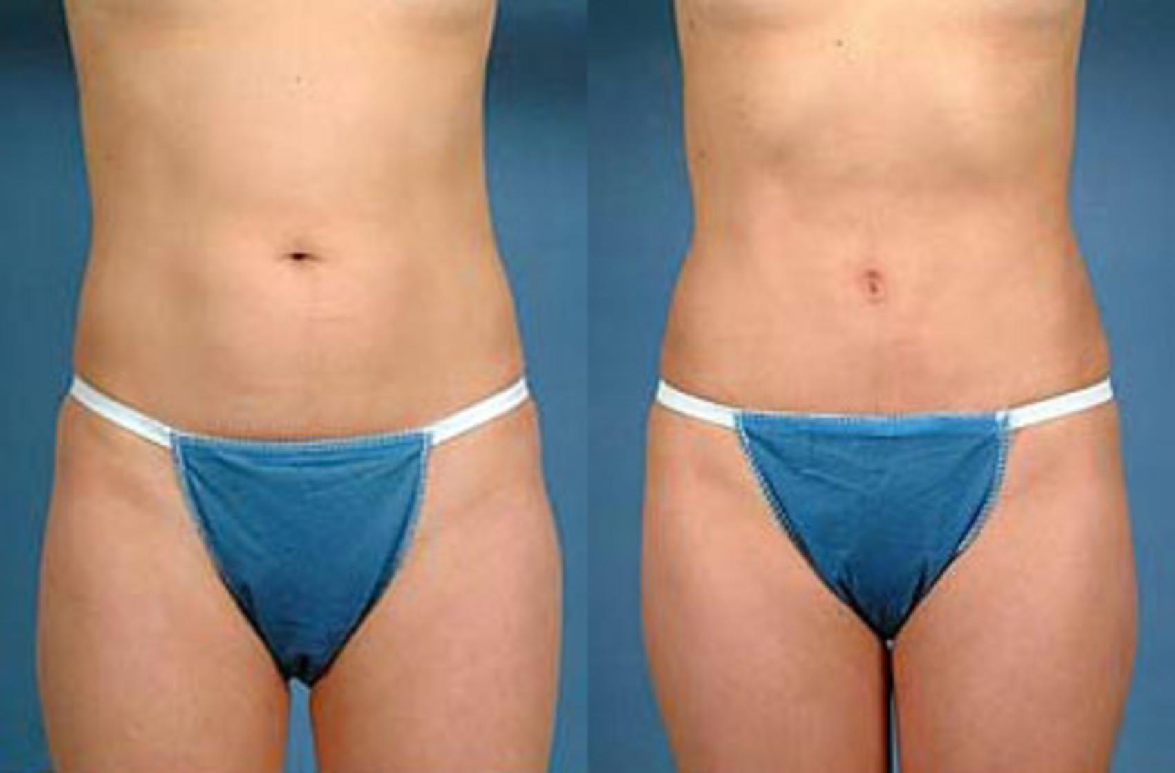 Before & After Liposuction for Women Case 145 View #1 View in Louisville & Lexington, KY
