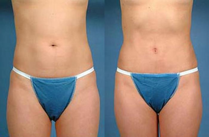 Before & After Liposuction for Women Case 145 View #1 View in Louisville, KY