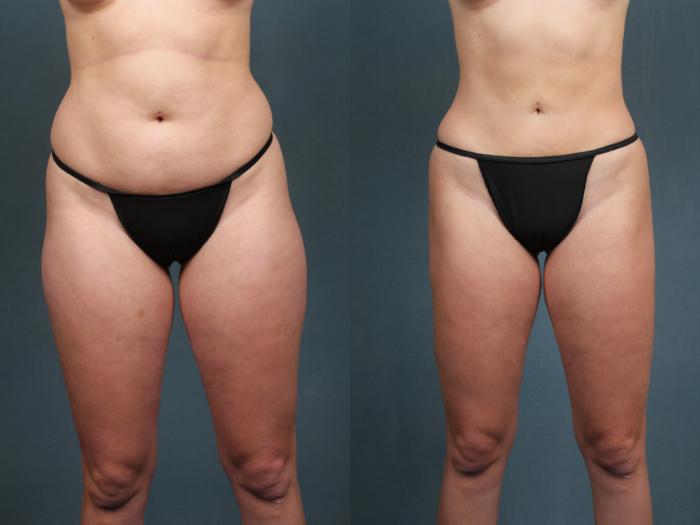 Before & After Liposuction for Women Case 593 View #1 View in Louisville, KY