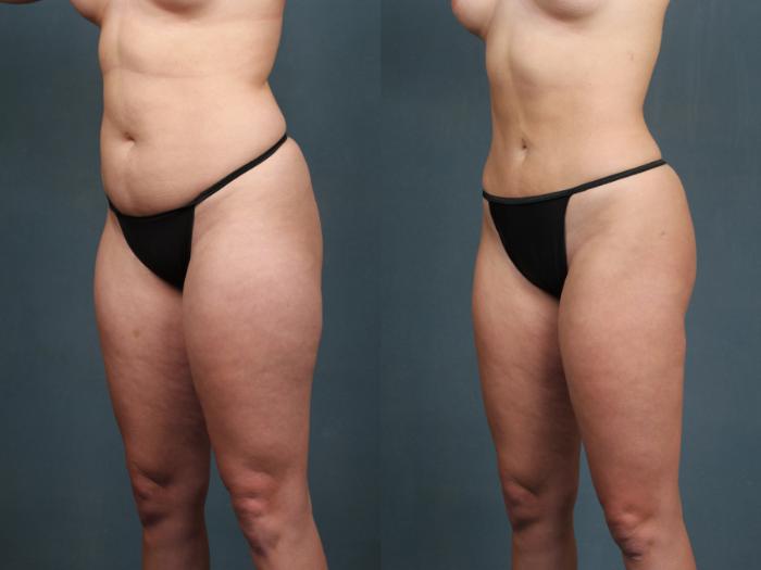 Before & After Liposuction for Women Case 593 View #2 View in Louisville, KY