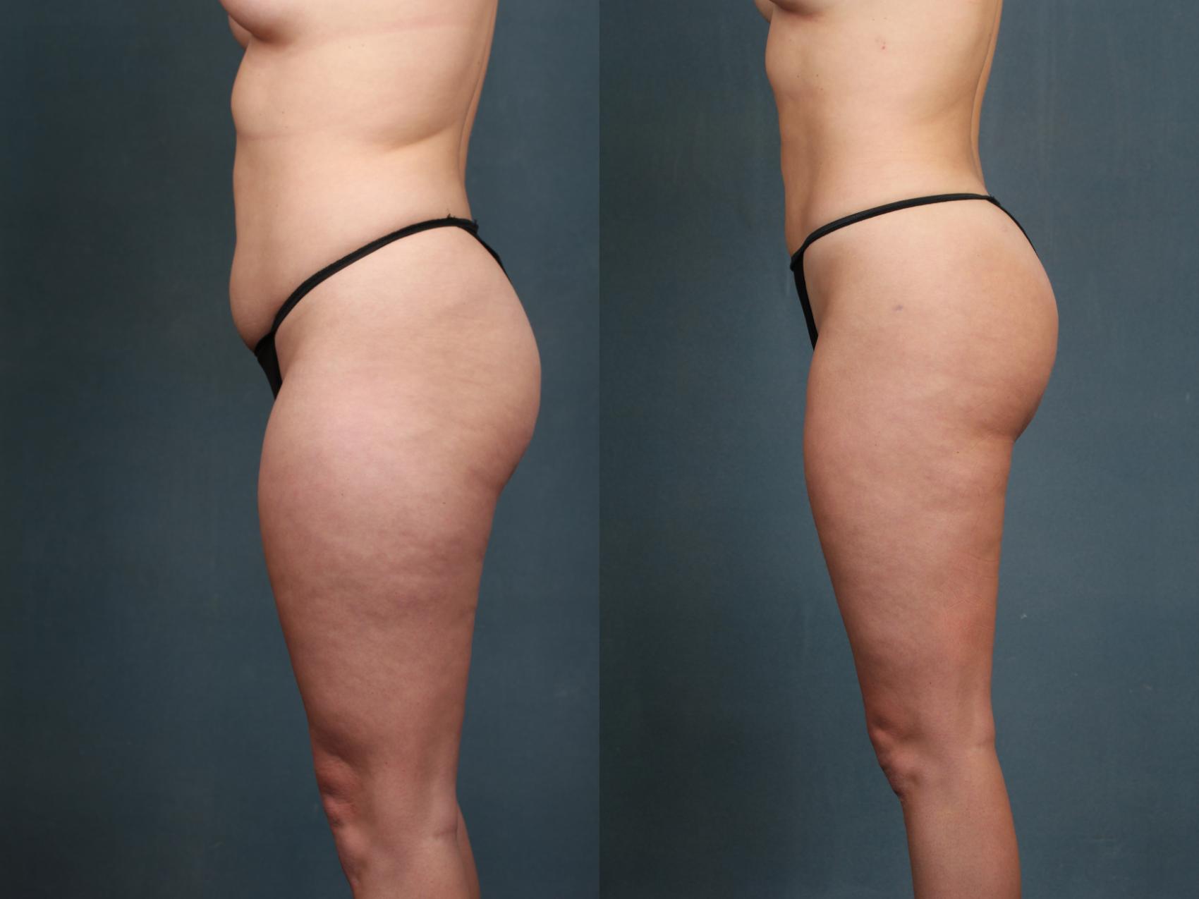 Before & After Liposuction for Women Case 593 View #3 View in Louisville, KY