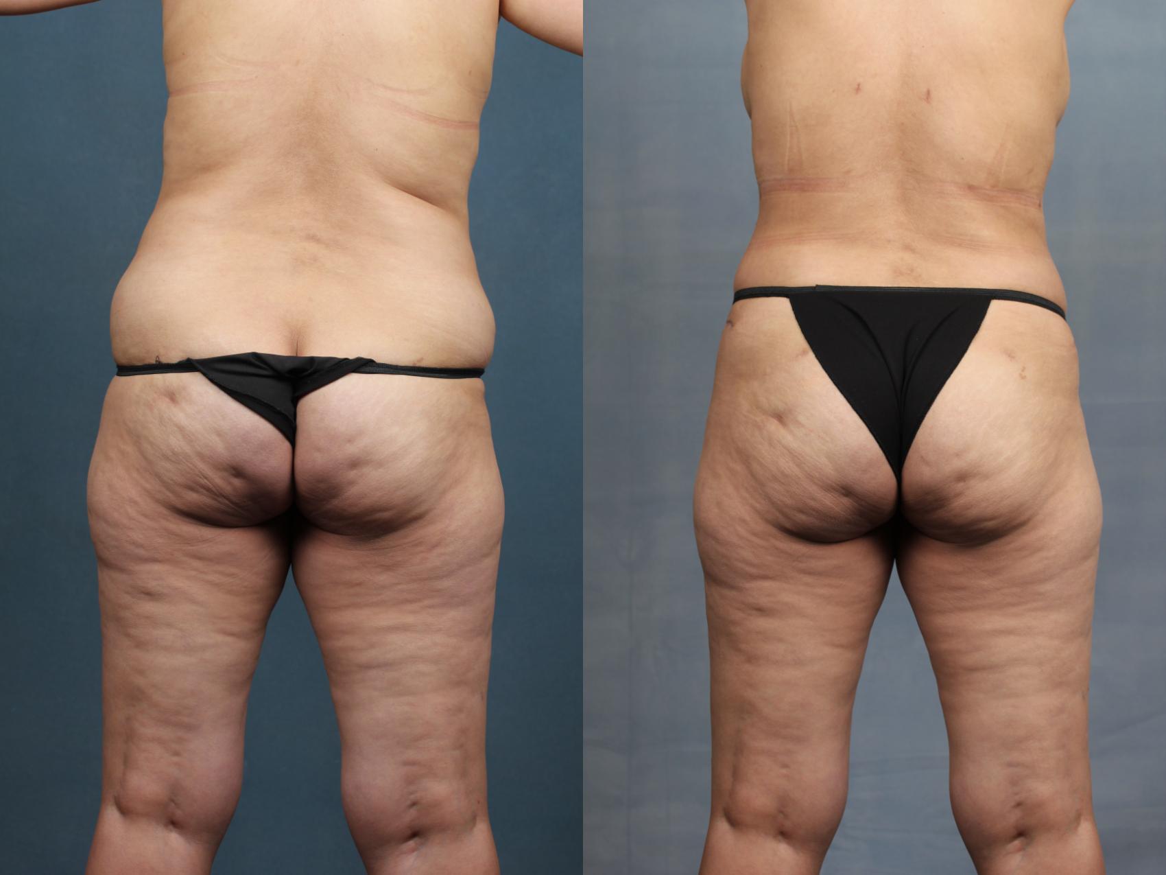 Before & After Liposuction for Women Case 604 View #1 View in Louisville & Lexington, KY