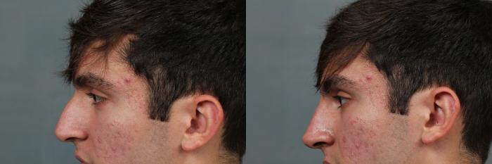 Before & After Liquid Rhinoplasty Case 650 Left Side View in Louisville & Lexington, KY