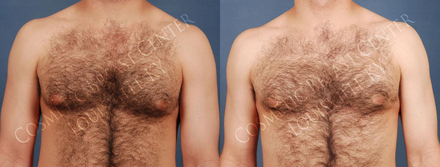 Before & After Male Reduction Case 219 View #1 View in Louisville & Lexington, KY