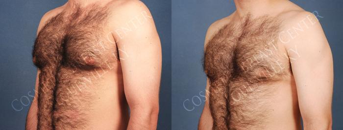 Male Reduction Case 219 Before & After View #2 | Louisville, KY | CaloSpa® Rejuvenation Center
