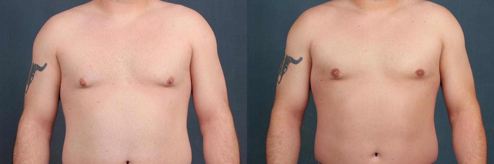 Before & After Male Reduction Case 559 View #1 View in Louisville, KY