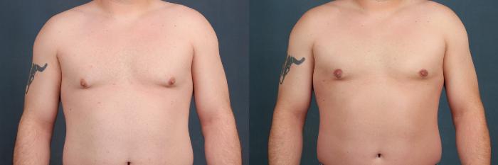 Male Reduction Case 559 Before & After View #1 | Louisville, KY | CaloSpa® Rejuvenation Center