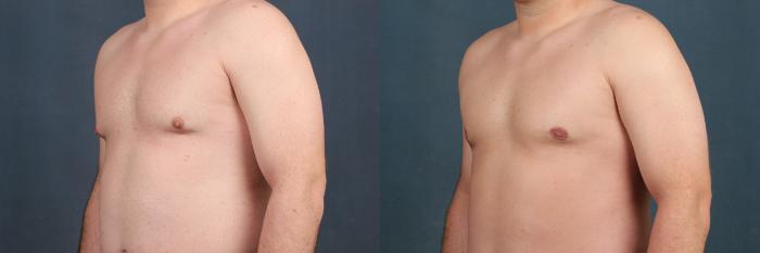 Male Reduction Case 559 Before & After View #2 | Louisville, KY | CaloSpa® Rejuvenation Center