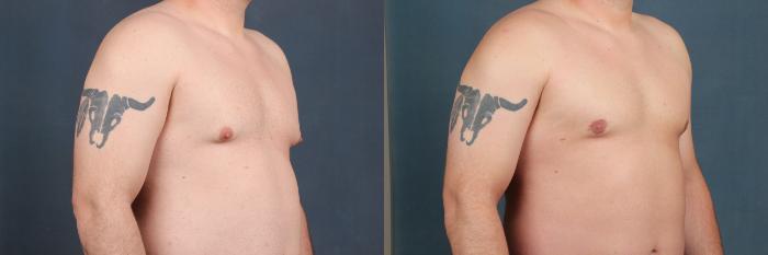 Before & After Male Reduction Case 559 View #3 View in Louisville & Lexington, KY