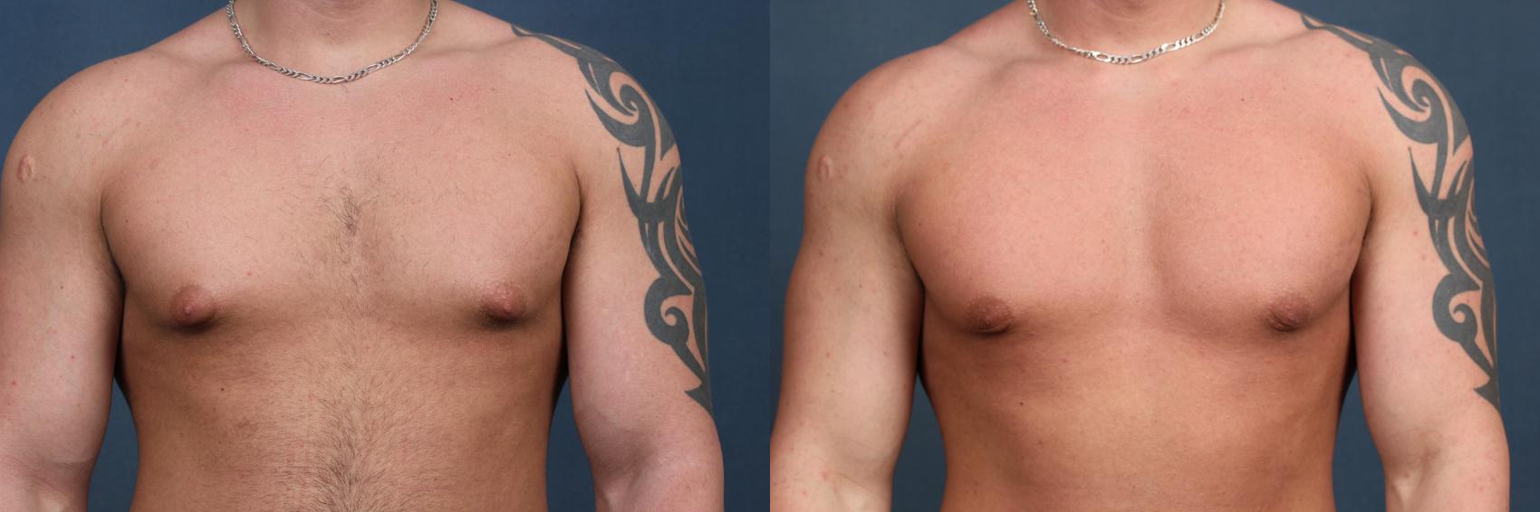 Before & After Male Reduction Case 560 View #1 View in Louisville, KY