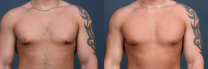 Male Reduction Case 560 Before & After View #1 | Louisville, KY | CaloSpa® Rejuvenation Center