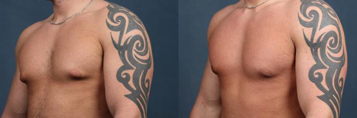 Before & After Male Reduction Case 560 View #2 View in Louisville & Lexington, KY