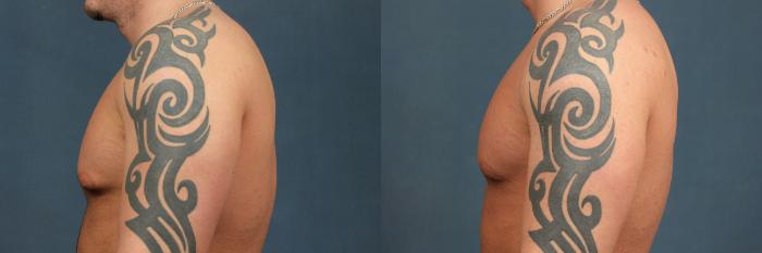 Male Reduction Case 560 Before & After View #3 | Louisville, KY | CaloSpa® Rejuvenation Center