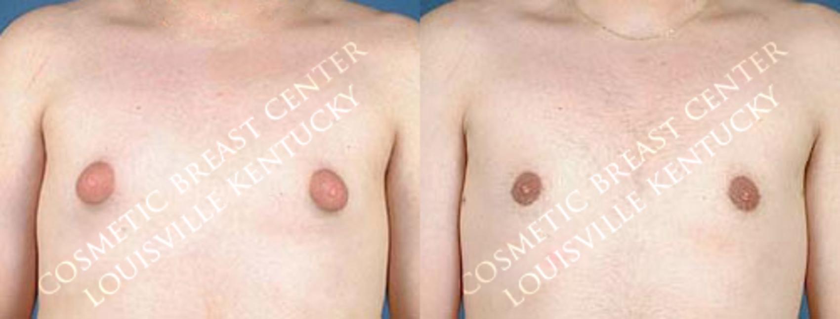 Before & After Male Reduction Case 60 View #1 View in Louisville, KY