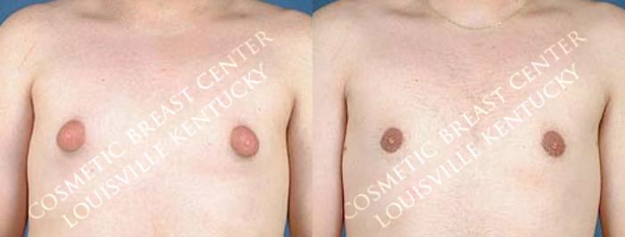 Before & After Male Reduction Case 60 View #1 View in Louisville & Lexington, KY