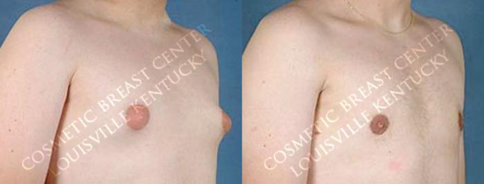 Male Reduction Case 60 Before & After View #2 | Louisville, KY | CaloSpa® Rejuvenation Center