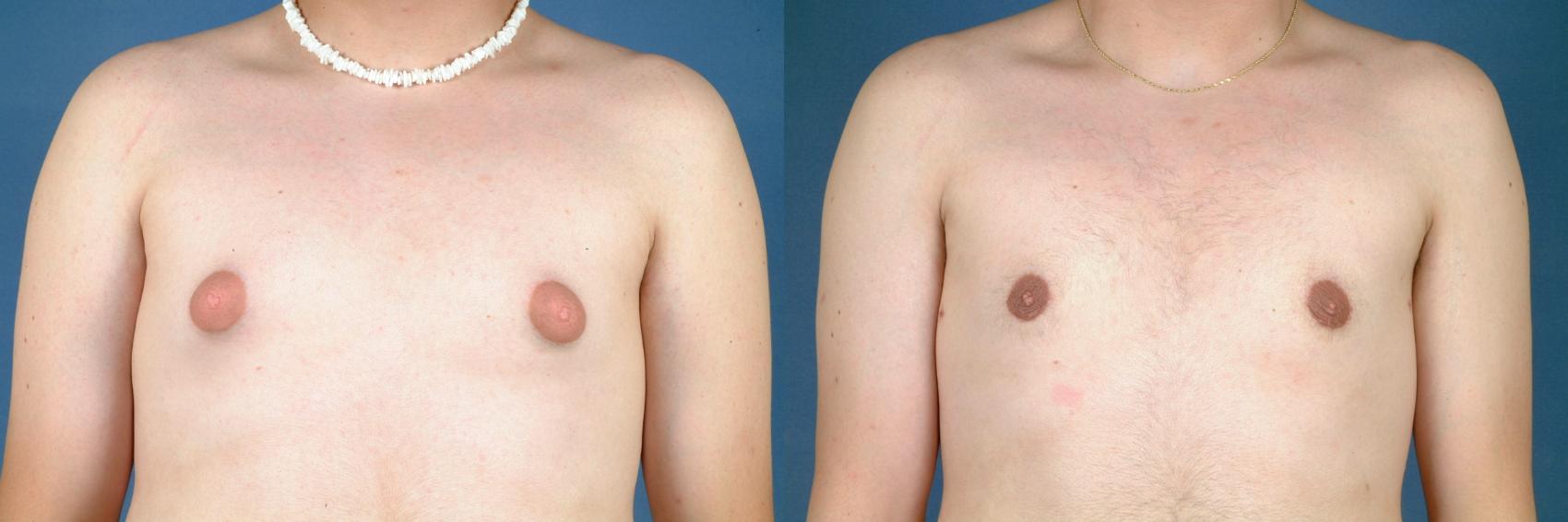 Before & After Male Breast Reduction Case 716 Front View in Louisville, KY