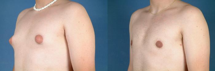 Male Reduction Case 716 Before & After Right Side | Louisville, KY | CaloSpa® Rejuvenation Center