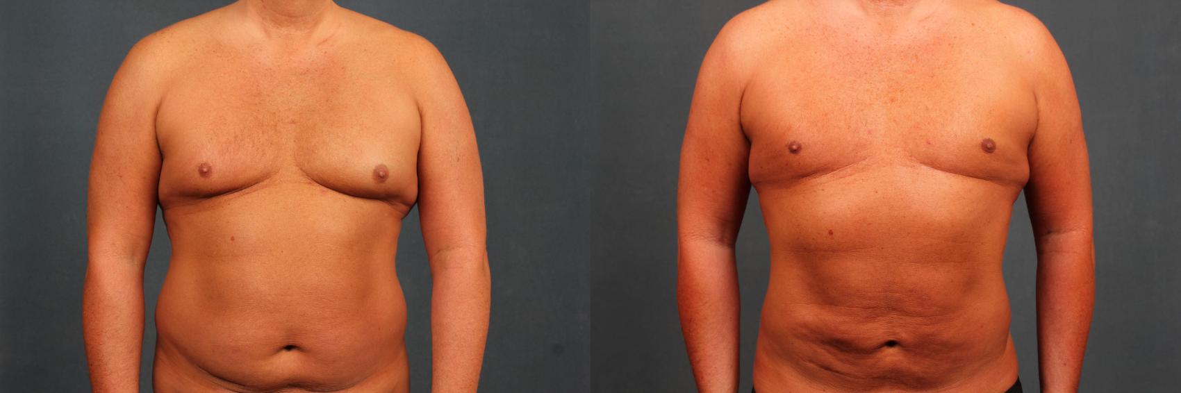 Before & After Male Breast Reduction Case 718 Front View in Louisville & Lexington, KY