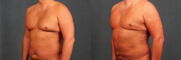 Male Breast Reduction Case 718 Before & After Right Oblique | Louisville, KY | CaloSpa® Rejuvenation Center