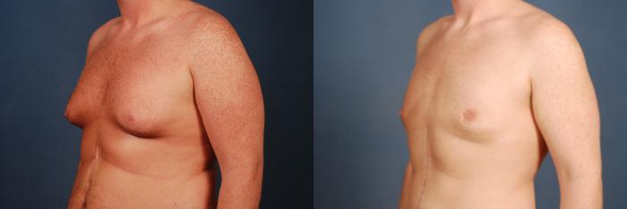Before & After Male Breast Reduction Case 724 Left Oblique View in Louisville & Lexington, KY