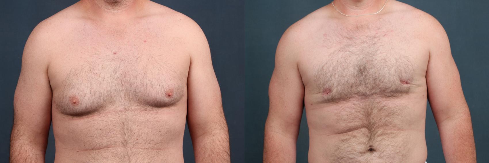 Before & After Male Breast Reduction Case 727 Front View in Louisville, KY