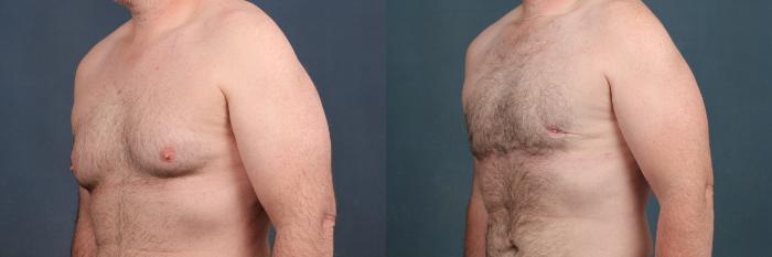 Before & After Male Breast Reduction Case 727 Left Oblique View in Louisville & Lexington, KY