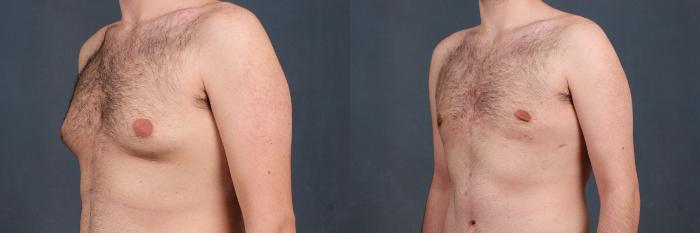 Before & After Male Breast Reduction Case 729 Left Oblique View in Louisville & Lexington, KY