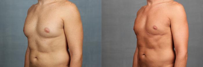 Before & After Male Breast Reduction Case 732 Left Oblique View in Louisville & Lexington, KY