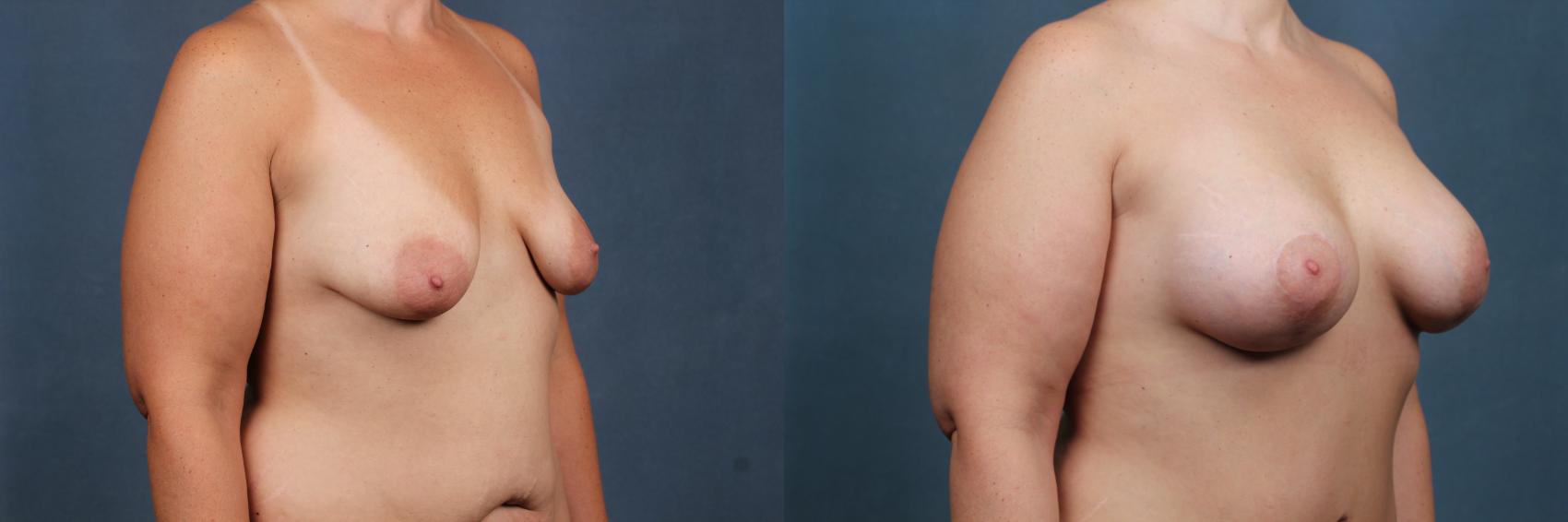 Before & After Mommy Makeover Case 737 Right Oblique View in Louisville, KY
