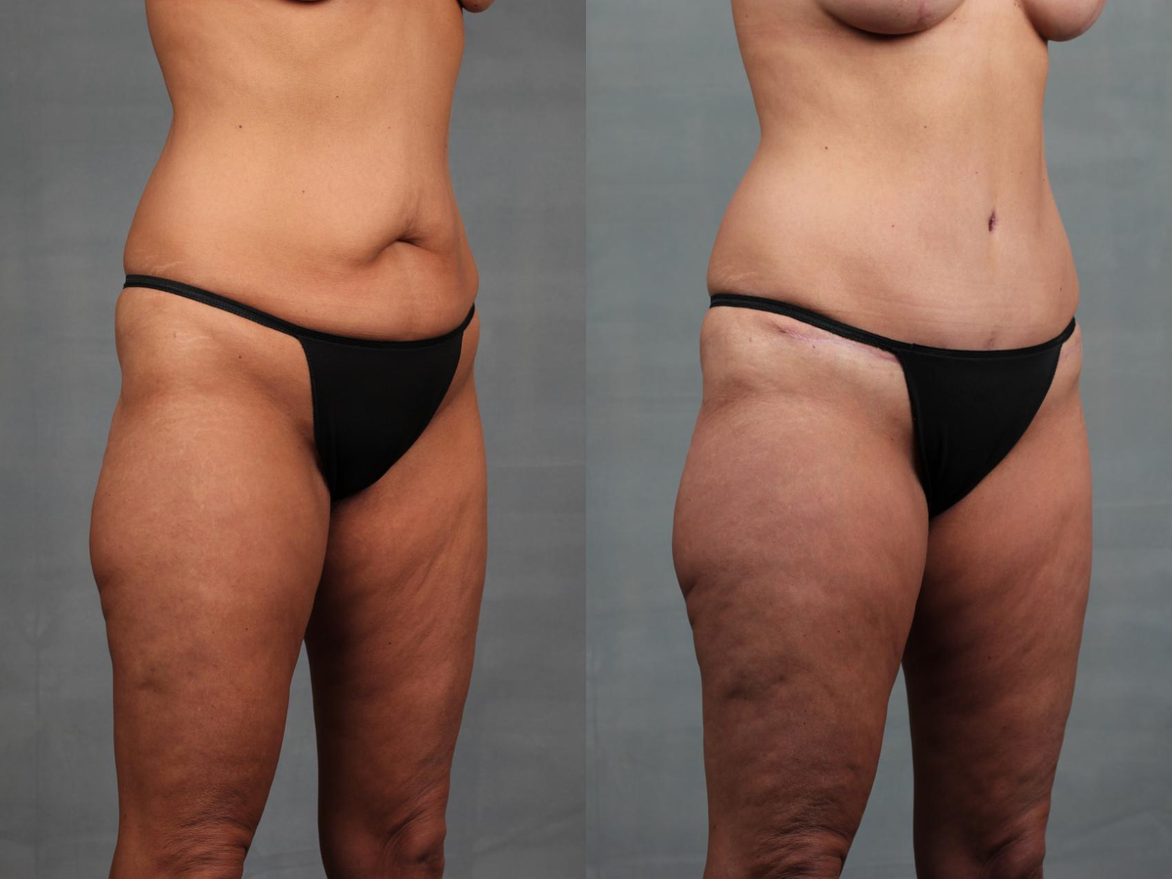 Before & After Mommy Makeover Case 738 Right Oblique - Bottom View in Louisville & Lexington, KY